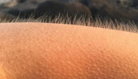 ფრისონი: ესთეტიკური შემცივნება, ფსიქოგენური კანკალი